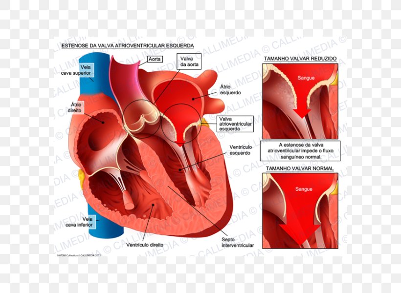 Aortic Insufficiency Aorta Aortic Stenosis Ventricle Aortic Valve