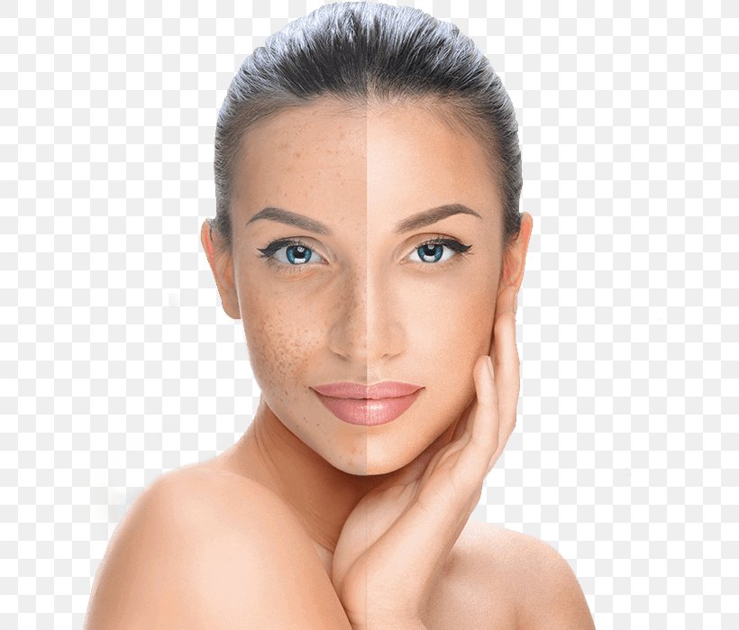 Chemical Peel Facial Skin Exfoliation Surgery, PNG, 645x699px, Chemical Peel, Acne, Beauty, Cheek, Chin Download Free
