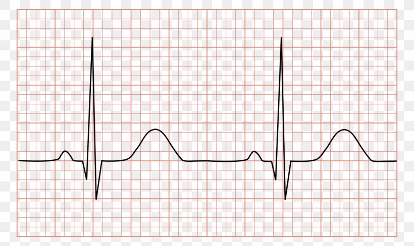 Electrocardiography QRS Complex Sinus Rhythm Heart Arrhythmia, PNG, 1280x763px, Watercolor, Cartoon, Flower, Frame, Heart Download Free