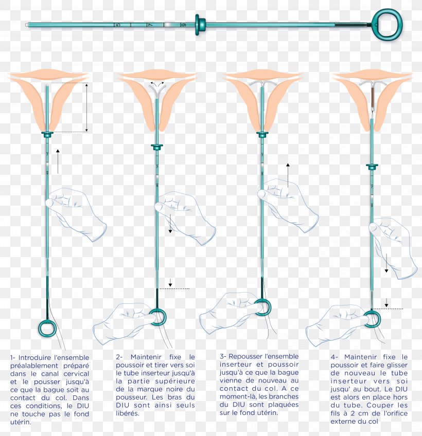 Intrauterine Device Uterus Copper IUDs Birth Control Pregnancy, PNG, 3879x4016px, Intrauterine Device, Birth Control, Copper Iuds, Empresa, Female Download Free