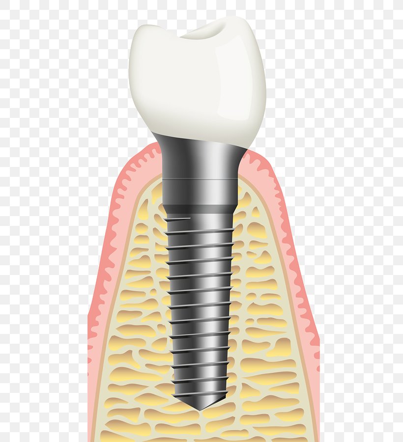 Bone Grafting Dental Implant Sinus Lift Dentist, PNG, 600x900px, Bone Grafting, Bone, Brush, Crown, Dental Implant Download Free