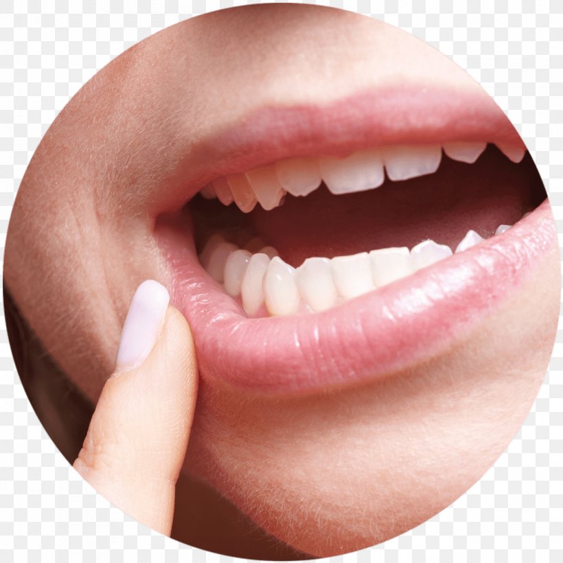 Aphthous Stomatitis Dentistry Mouth Ulcer Gums, PNG, 1260x1260px, Aphthous Stomatitis, Aloe Vera, Bleeding On Probing, Cheek, Chin Download Free