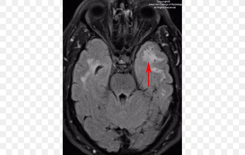 Computed Tomography Brain Organism, PNG, 550x520px, Watercolor, Cartoon, Flower, Frame, Heart Download Free