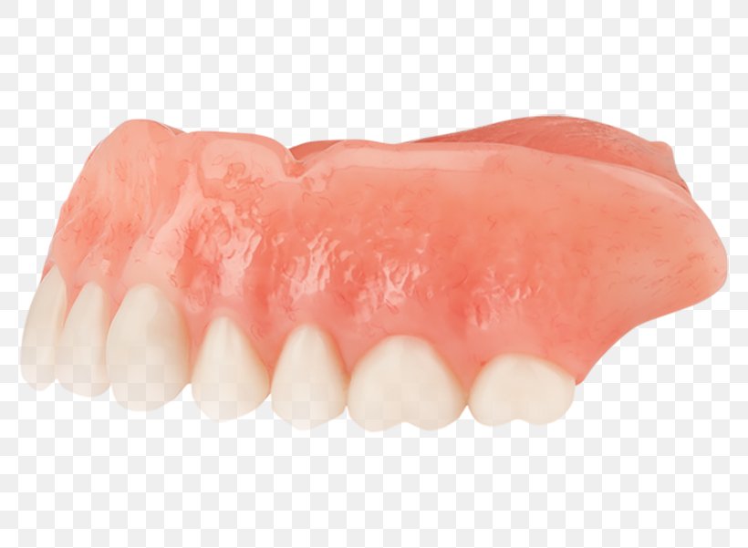 Dentures Tooth Dentistry Dental Implant, PNG, 800x601px, Dentures, Aspen Dental, Brewer Dental Center, Bridge, Child Download Free