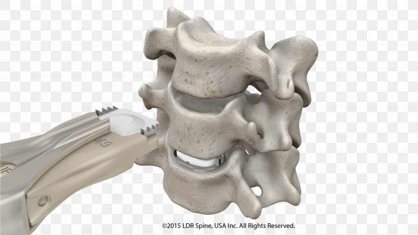Intervertebral Disc Arthroplasty Anterior Cervical Discectomy And Fusion Spinal Fusion Implant, PNG, 3556x2000px, Intervertebral Disc Arthroplasty, Auto Part, Bone, Cervical Vertebrae, Discectomy Download Free