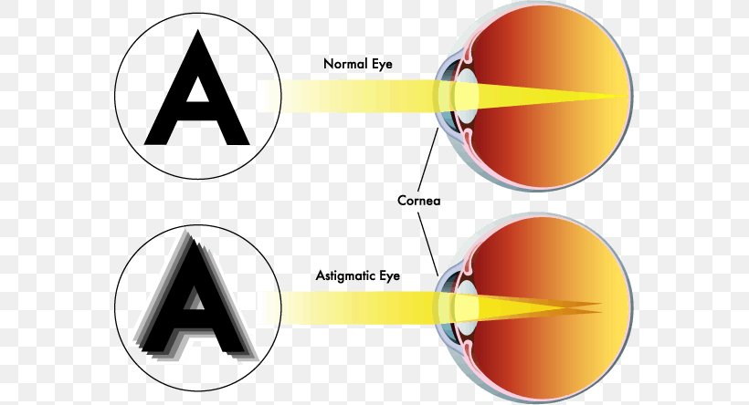Astigmatism Near-sightedness Eye Far-sightedness Visual Perception, PNG, 569x444px, Astigmatism, Brand, Contact Lenses, Cornea, Diagram Download Free