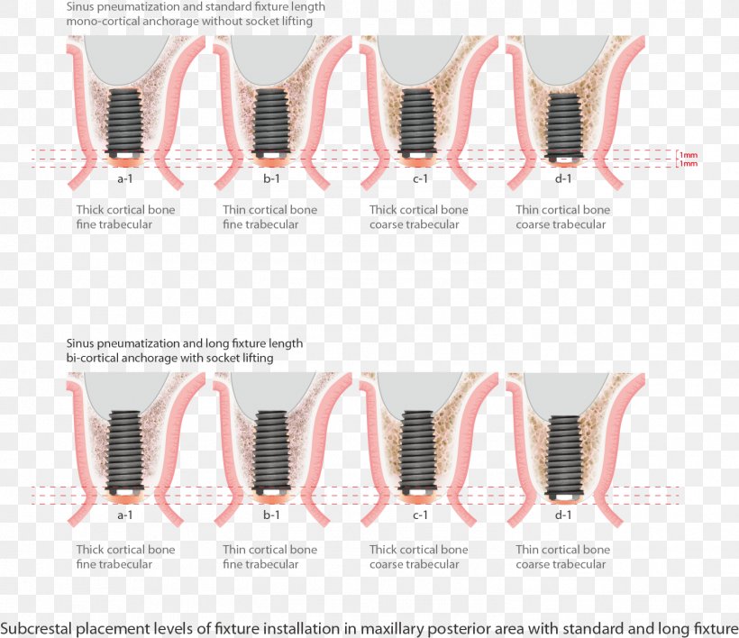 Dental Implant Maxillary Sinus Tooth Bone, PNG, 1471x1271px, Dental Implant, Anchorage, Bone, Clothing Accessories, Fashion Download Free