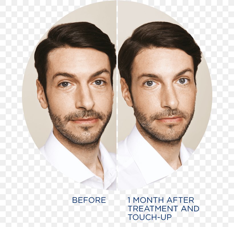 Restylane Wrinkle Beard Botulinum Toxin Dermatology, PNG, 668x795px, Restylane, Ageing, Antiaging Cream, Beard, Blepharoplasty Download Free