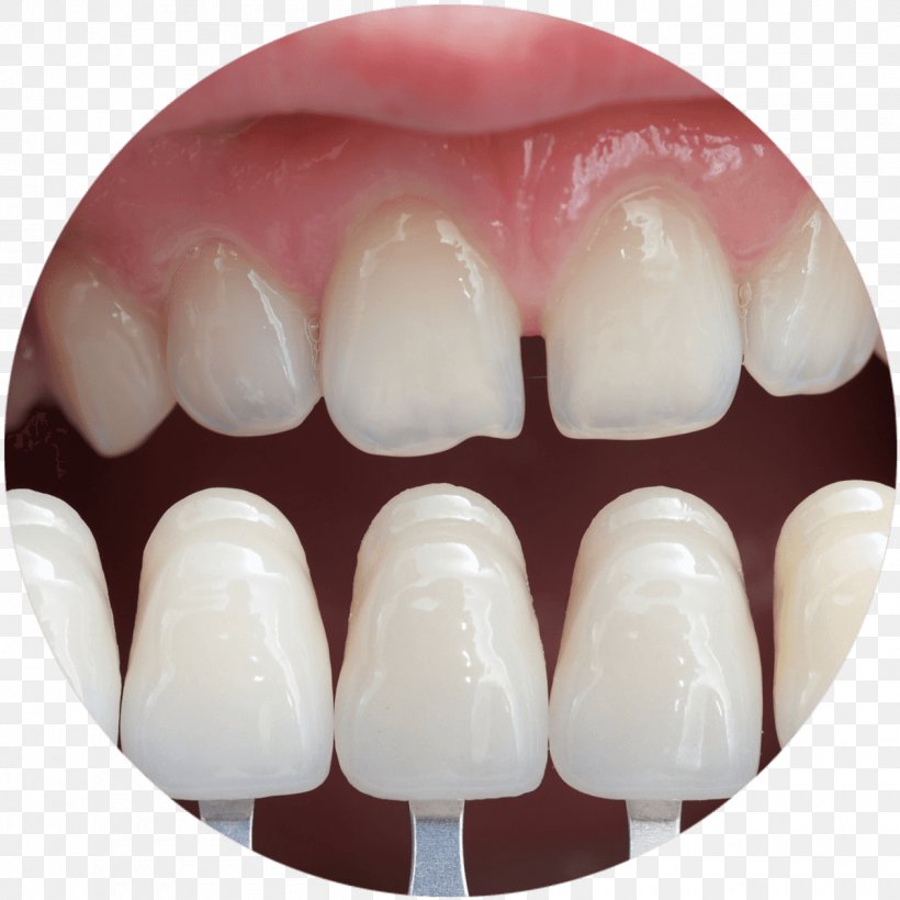 Veneer Cosmetic Dentistry Bridge, PNG, 1260x1260px, Veneer, Bridge, Cosmetic Dentistry, Crown, Dental Implant Download Free