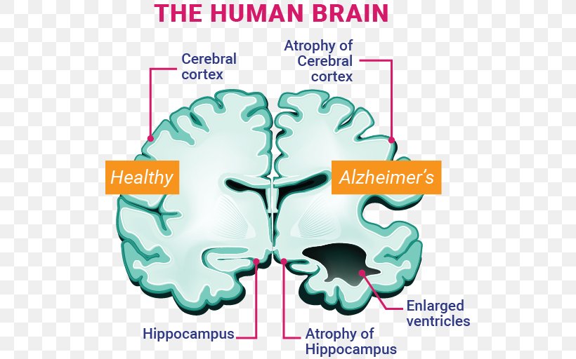 Alzheimer's Disease Amyloid Beta Brain, PNG, 520x512px, Watercolor, Cartoon, Flower, Frame, Heart Download Free