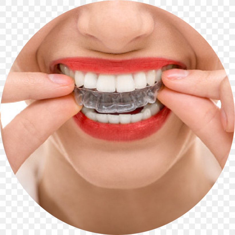 Orthodontics Dentistry Dental Braces Clear Aligners, PNG, 1205x1205px, Orthodontics, Chin, Clear Aligners, Cosmetic Dentistry, Dental Braces Download Free
