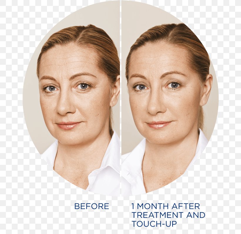 Restylane Periorbital Puffiness Wrinkle Eye Injectable Filler, PNG, 668x795px, Restylane, Ageing, Beauty, Blepharoplasty, Cheek Download Free
