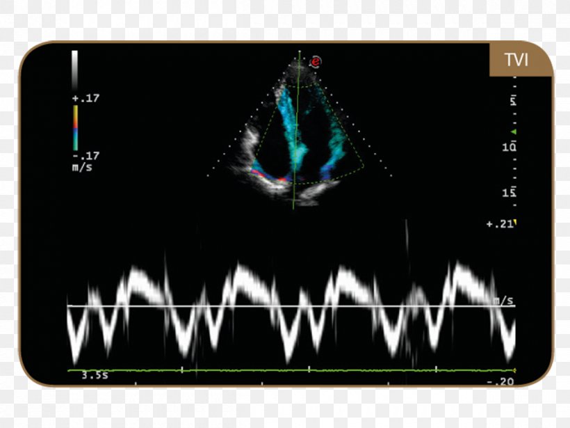 Ultrasonography Tissue Doppler Echocardiography Ultrasound Esaote Technology, PNG, 1200x900px, Ultrasonography, Brand, Electronic Device, Electronics, Enddiastolic Volume Download Free