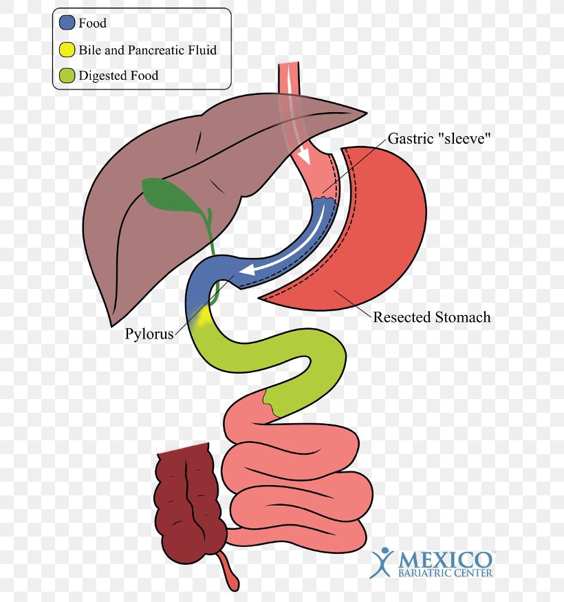 Duodenal Switch Sleeve Gastrectomy Bariatric Surgery Gastric Bypass Surgery, PNG, 700x875px, Watercolor, Cartoon, Flower, Frame, Heart Download Free