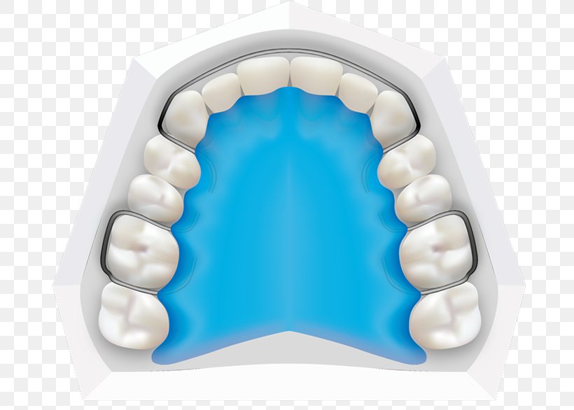 Tooth Orthodontics Dental Braces Dentistry Orthodontist, PNG, 700x586px, Tooth, Adolescence, Child, Deciduous Teeth, Dental Arch Download Free