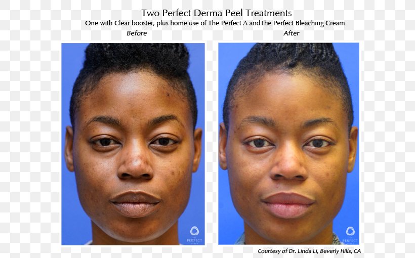 Chemical Peel Dermis Skin The Perfect Derma Peel Face, PNG, 646x510px, Chemical Peel, Cheek, Child, Chin, Complexion Download Free