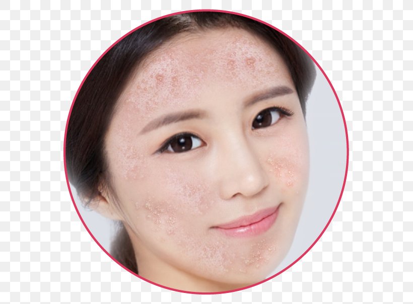 Mụn Eyebrow Acne Forehead Skin Care, PNG, 612x604px, Mun, Acne, Cheek, Chin, Close Up Download Free