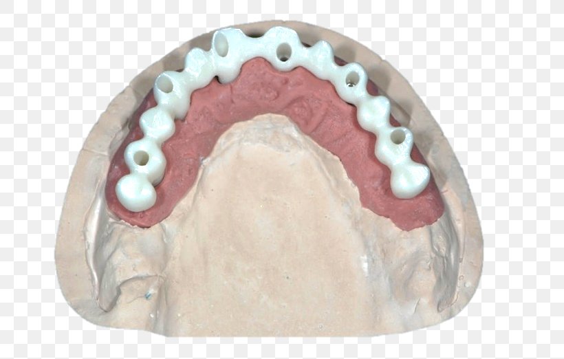 Bridge Jaw Dental Implant Diagnostic Wax-up Zirconium Dioxide, PNG, 785x522px, Bridge, Dental Implant, Dentition, Diagnostic Waxup, Image Scanner Download Free