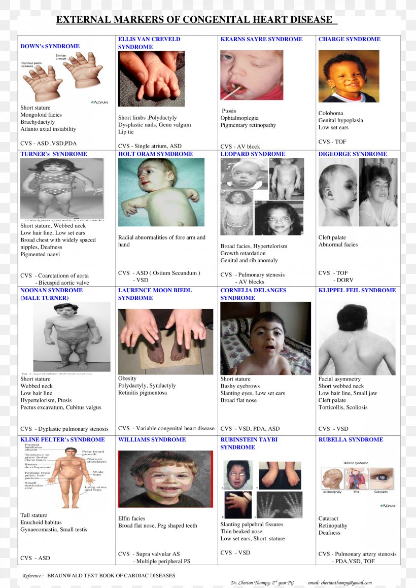 Facies Down Syndrome Congenital Heart Defect Disease, PNG, 2339x3308px, Facies, Advertising, Birth Defect, Chin, Congenital Heart Defect Download Free