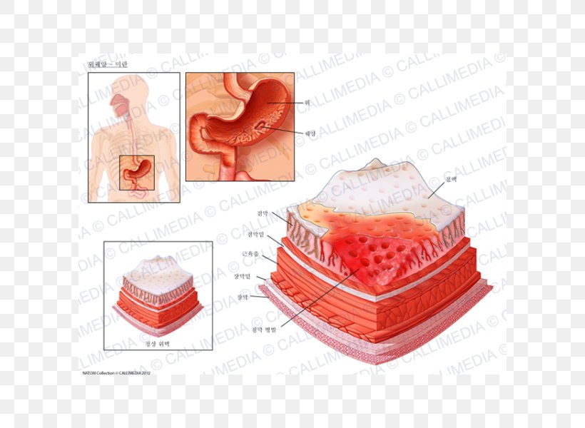Peptic Ulcer Disease Skin Ulcer Erosion Mucous Membrane Mouth Ulcer, PNG, 600x600px, Peptic Ulcer Disease, Balanitis, Erosion, Gastric Mucosa, Gastritis Download Free