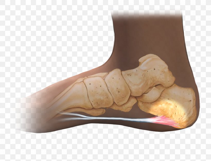 Plantar Fasciitis Foot Sole Shoulder Therapy, PNG, 2000x1527px, Plantar Fasciitis, Ache, Arm, Bone, Cause Download Free