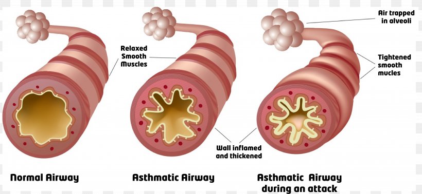 Cardiac Asthma Respiratory Tract Reactive Airway Disease Lung, PNG