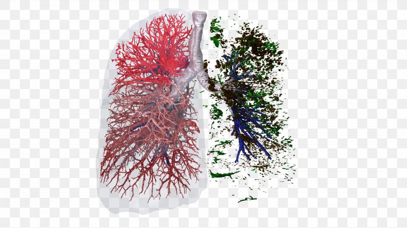 Clinical Trial Lung Respiratory System FLUIDDA Nv Information, PNG, 3840x2160px, Clinical Trial, Algorithm, Artificial Intelligence, Bronchiolitis Obliterans, Data Download Free