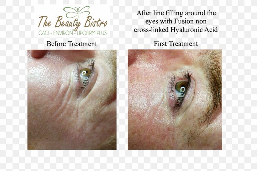 Eyelash Extensions Wrinkle Cosmetics Cheek Mesotherapy, PNG, 1100x733px, Eyelash Extensions, Cheek, Chin, Close Up, Cosmetics Download Free