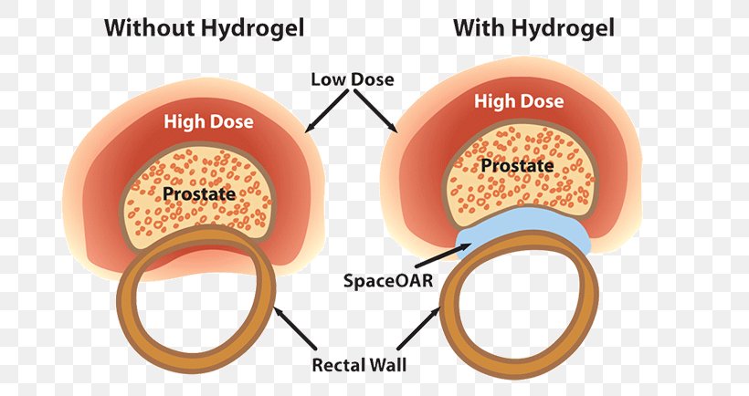 Radiation Therapy Prostate Cancer Hydrogel Treatment Of Cancer, PNG, 800x434px, Watercolor, Cartoon, Flower, Frame, Heart Download Free