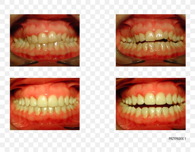 Gums Gingivoplasty Human Tooth Surgery, PNG, 1024x800px, Gums, Camera, Close Up, Gingivoplasty, Human Tooth Download Free