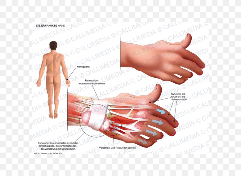 Thumb Product Design Hand Model Subcutaneous Nodules, PNG, 600x600px, Watercolor, Cartoon, Flower, Frame, Heart Download Free