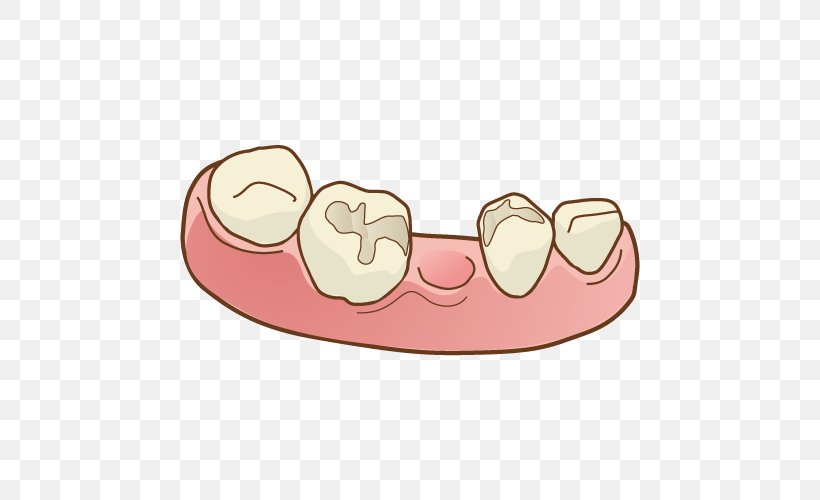 Dentist Tooth Bridge Dentures 人工歯, PNG, 500x500px, Dentist, Bridge, Dental Implant, Dentistry, Dentures Download Free