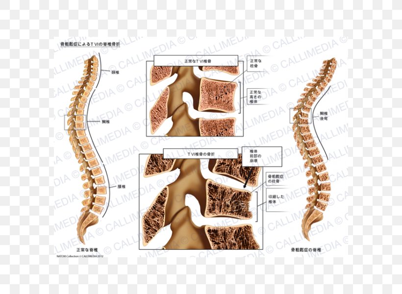 Bone Fracture Osteoporosis Vertebral Column Anatomy, PNG, 600x600px, Watercolor, Cartoon, Flower, Frame, Heart Download Free