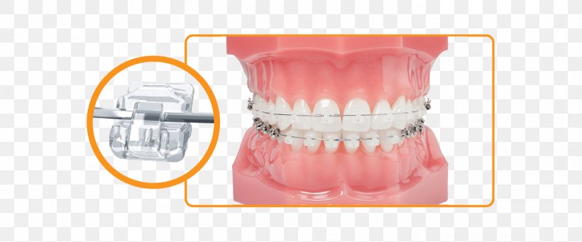 Dental Braces Damon System Orthodontics Dentistry, PNG, 1500x625px, Dental Braces, Clear Aligners, Damon System, Dental Implant, Dentist Download Free
