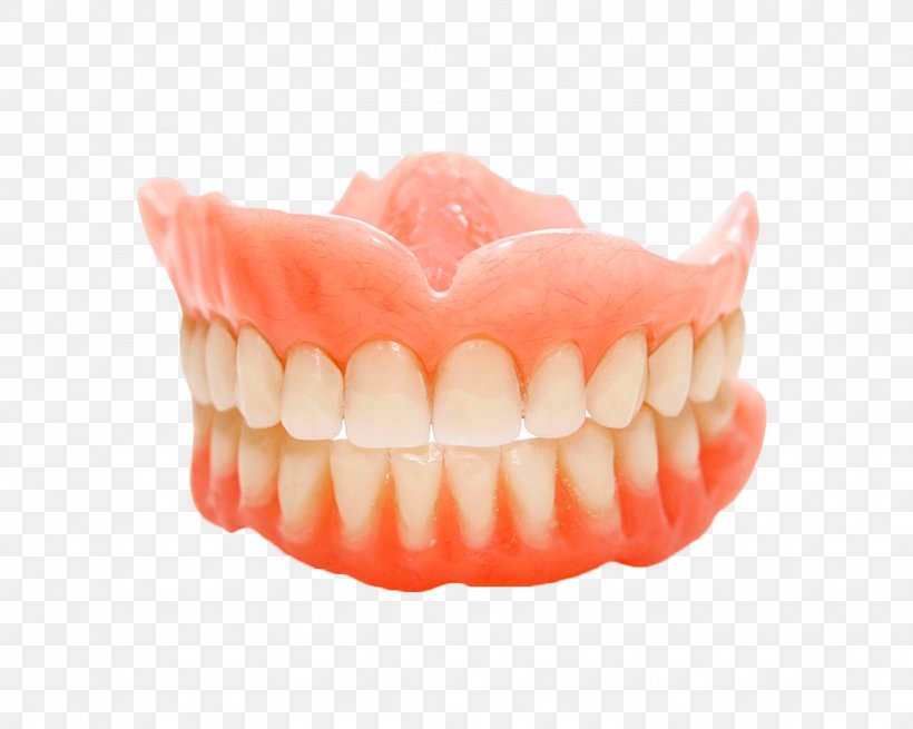 Dentures Removable Partial Denture Dental Implant Dentistry, PNG, 1024x819px, Dentures, Bridge, Chewing, Cosmetic Dentistry, Crown Download Free