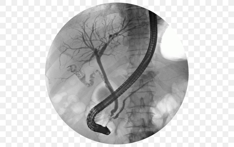 Endoscopic Retrograde Cholangiopancreatography Bile Duct Endoscopy Gallstone, PNG, 519x515px, Bile Duct, Bile, Biliary Tract, Black And White, Common Bile Duct Download Free