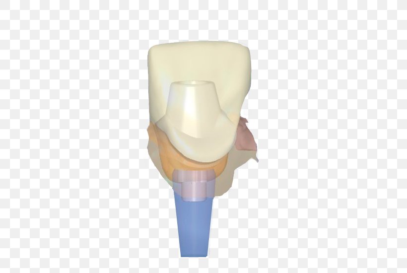 Dental Implant Abutment Crown Zirconium Dioxide, PNG, 550x550px, Dental Implant, Abutment, Bridge, Collar, Crown Download Free