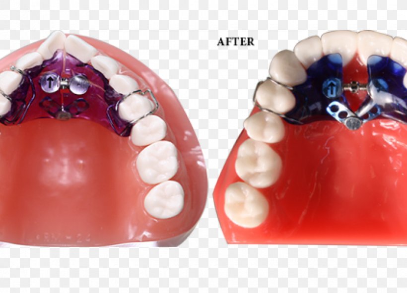 Orthodontics Home Appliance Palatal Expansion Orthodontic Technology Jaw, PNG, 970x700px, Orthodontics, Arch, Augers, Clear Aligners, Crossbite Download Free