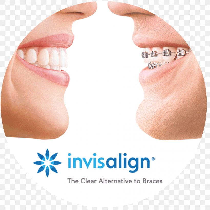 Clear Aligners Dental Braces Orthodontics Dentistry Retainer, PNG, 880x880px, Clear Aligners, Cheek, Chin, Cosmetic Dentistry, Damon System Download Free