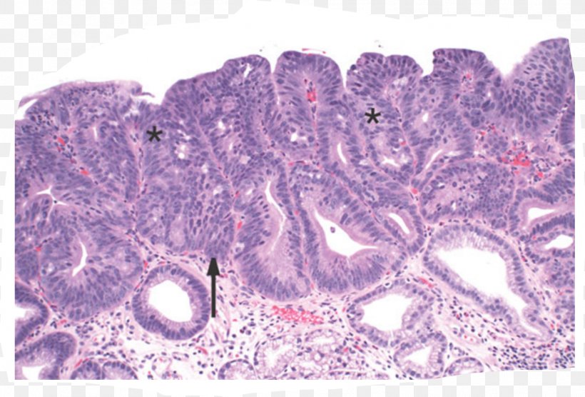 Barrett's Esophagus Intestinal Metaplasia Epithelium Adenocarcinoma, PNG, 1504x1020px, Esophagus, Adenocarcinoma, Disease, Dysplasia, Epithelium Download Free