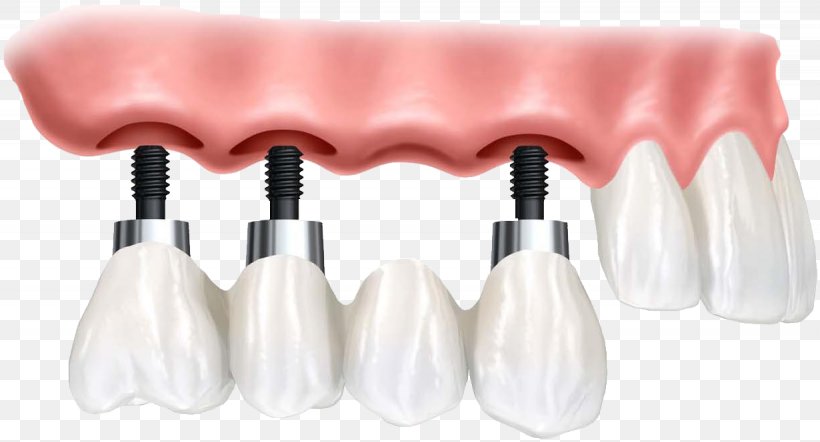 Dental Implant Dentistry Dentures Tooth Loss, PNG, 1230x664px, Dental Implant, Bridge, Brush, Cosmetics, Crown Download Free