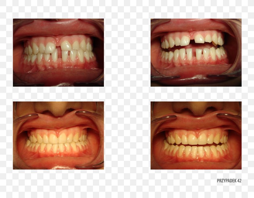 Tooth Close-up Therapy Patient .pl, PNG, 1024x800px, Tooth, Chin, Close Up, Closeup, Jaw Download Free