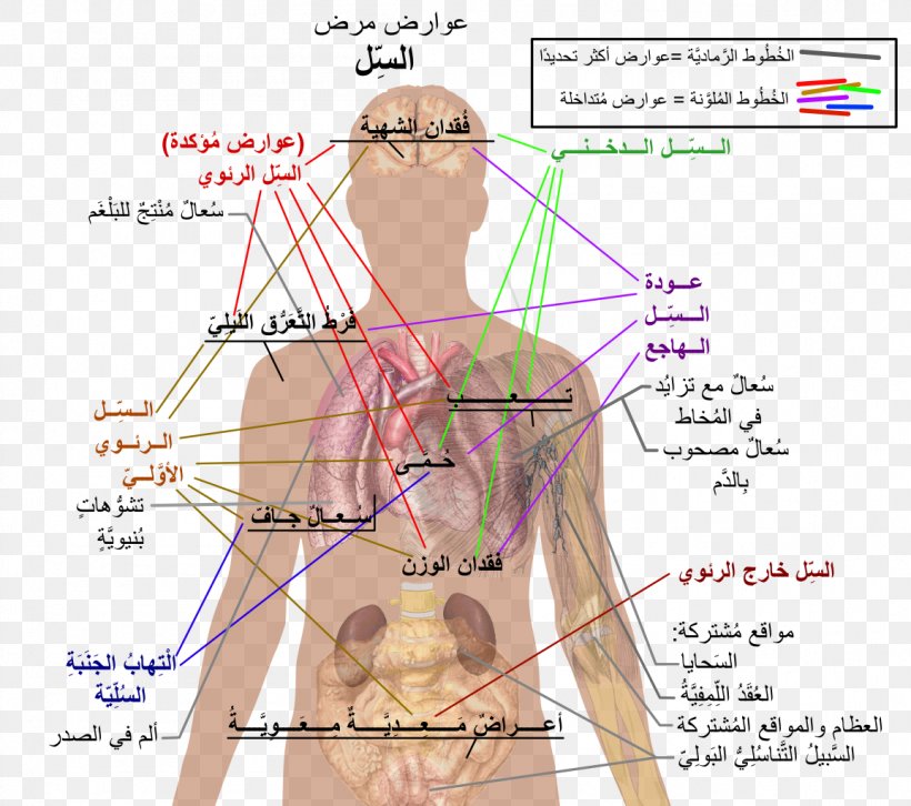 Mycobacterium Tuberculosis Infection Disease Symptom, PNG, 1155x1024px, Watercolor, Cartoon, Flower, Frame, Heart Download Free