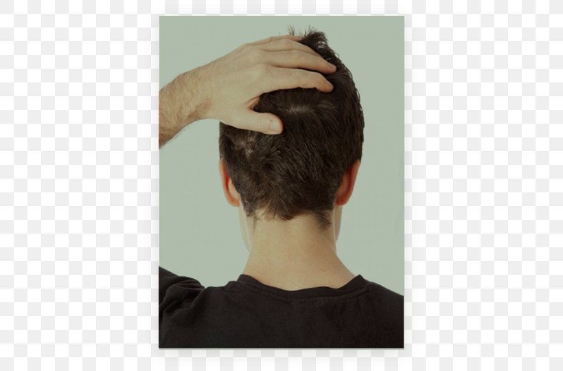 Scalp Nape Headache Pain Hair Loss, PNG, 700x540px, Scalp, Cyst, Disease, Ear, Forehead Download Free