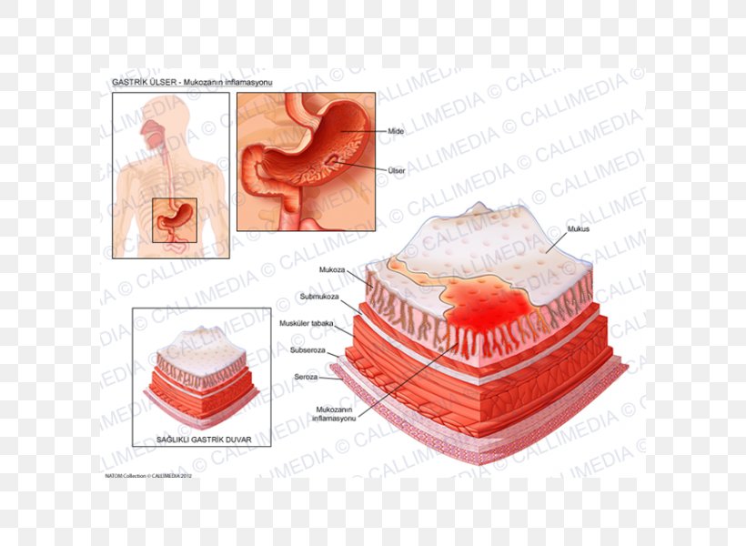 Peptic Ulcer Disease Skin Ulcer Erosion Inflammation Gastritis, PNG, 600x600px, Peptic Ulcer Disease, Disease, Erosion, Gastritis, Gastroenterology Download Free