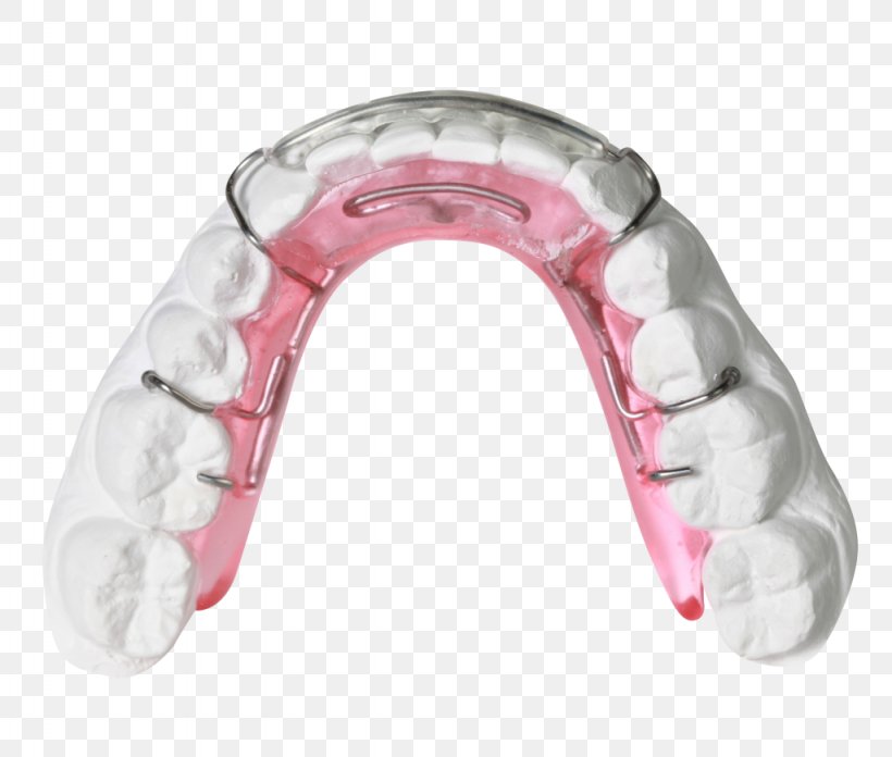 Clear Aligners Orthodontics Orthodontic Technology Jaw Bionator, PNG, 1024x870px, Clear Aligners, Bionator, David Gergen, Dentistry, Jaw Download Free