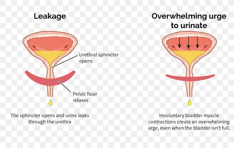 Overactive Bladder Urinary Bladder Urinary Incontinence Urethral Sphincters, PNG, 1024x650px, Overactive Bladder, Diagram, Drinkware, Kidney, Muscle Download Free