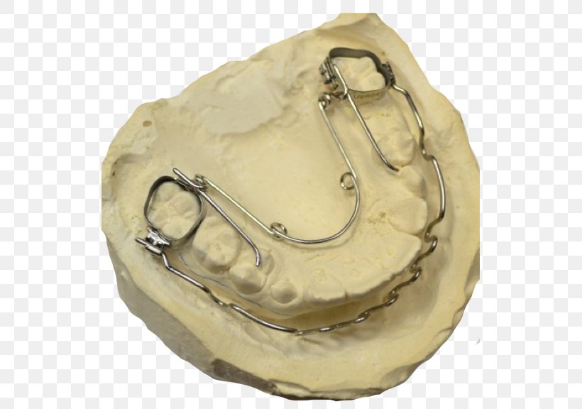 Quad Helix Orthodontics Jaw Moscow Orthodontic Laboratory, PNG, 533x576px, Quad Helix, Article, Beige, Helix, Instagram Download Free
