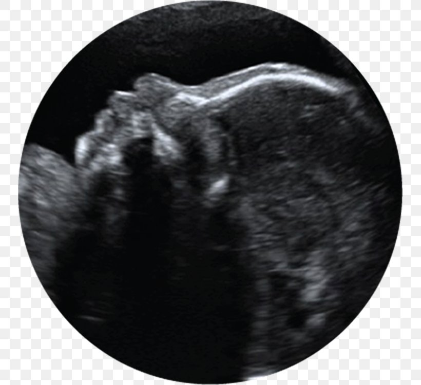 3D Ultrasound Ultrasonography Pregnancy Infant, PNG, 750x750px, 3d Ultrasound, Ultrasound, Amniotic Fluid, Black And White, Childbirth Download Free