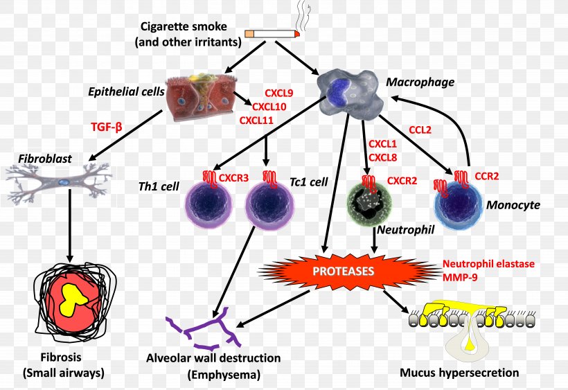Acute Exacerbation Of Chronic Obstructive Pulmonary Disease Inflammation Eosinophil, PNG, 5817x3995px, Inflammation, Area, Asthma, Diagram, Disease Download Free